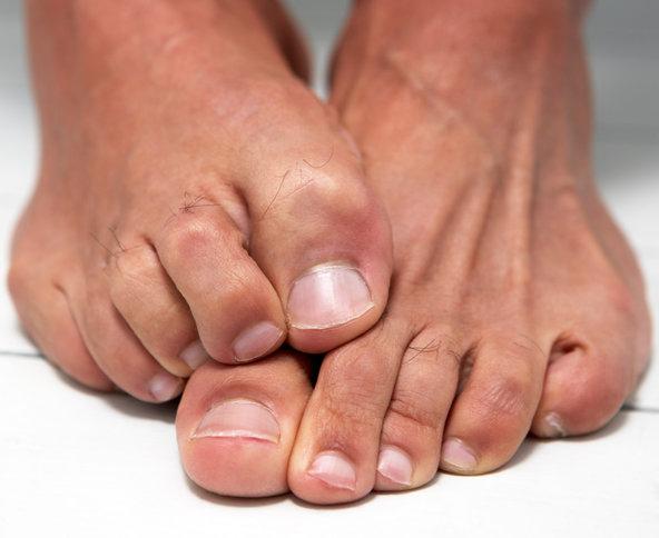 Nesreća gljiva na noktima stopala: liječenje s narodnim lijekovima